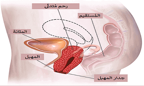 اعراض هبوط الرحم
