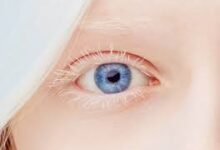 علاج المهق العيني