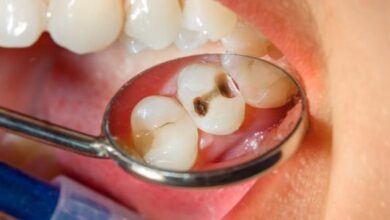 ما هي هشاشة الأسنان؟