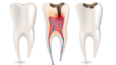 عصب الاسنان